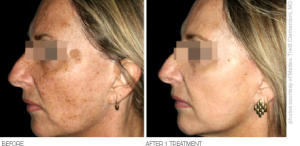 laser skin resurfacing- Skin & Vein Center- Michigan 800-400-VEIN