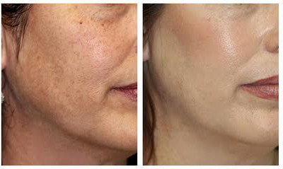 MicrodermabrasionBeforeAndAfter