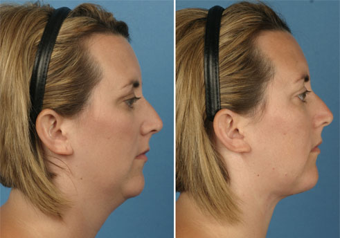 necklift- Skin & Vein Center- Michigan