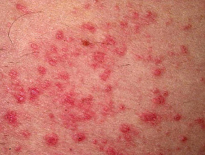 how to treat eczema