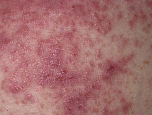 how to treat eczema