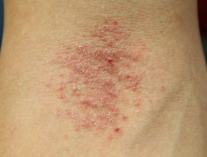 The Differences Between Rashes and Eczema (And How to Tell Which One You  Have)