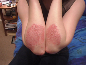 psoriasis2