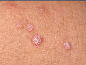 wart treatment- Skin & Vein Center Michigan