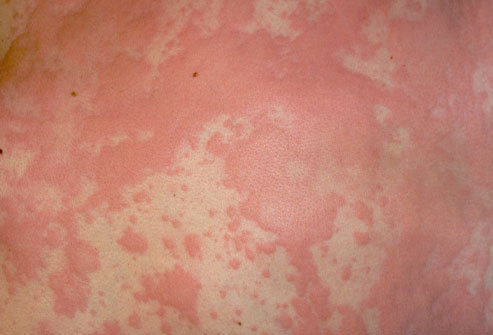 bad_skin_rash