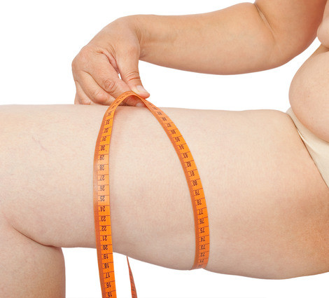 Liposuction stretch marks