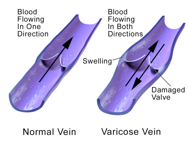 Inverted nipple - Wikipedia