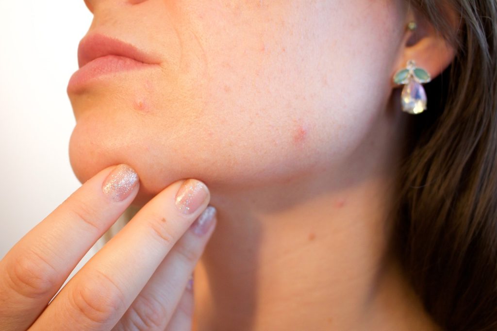 Acne clearable with michigan microdermabrasion