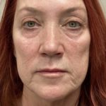 Mini Facelift Before & After Patient #7455
