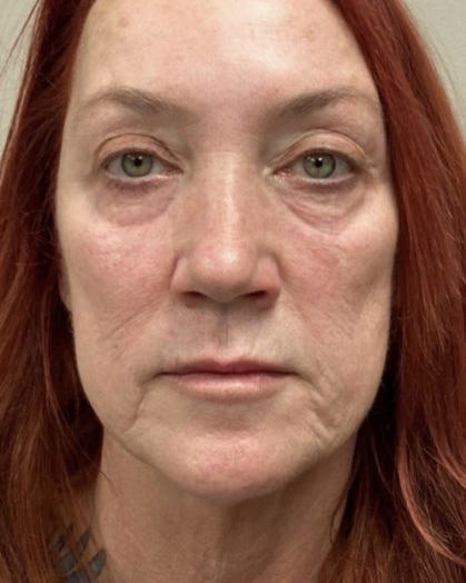 Mini Facelift Before & After Patient #7455