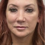 Mini Facelift Before & After Patient #7455
