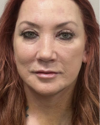 Mini Facelift Before & After Patient #7455