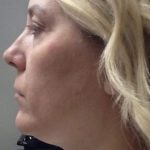 Mini Facelift Before & After Patient #7452