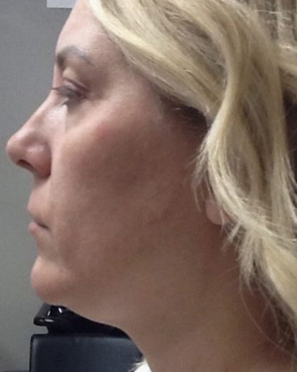Mini Facelift Before & After Patient #7452