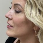 Mini Facelift Before & After Patient #7452