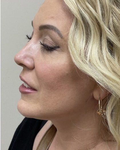 Mini Facelift Before & After Patient #7452