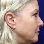 Facelift Before & After Patient #7444