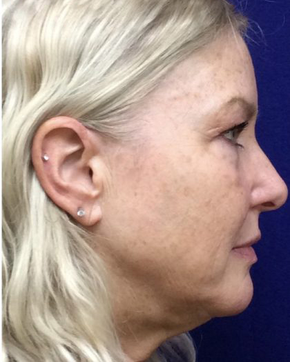Facelift Before & After Patient #7444