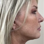 Facelift Before & After Patient #7444