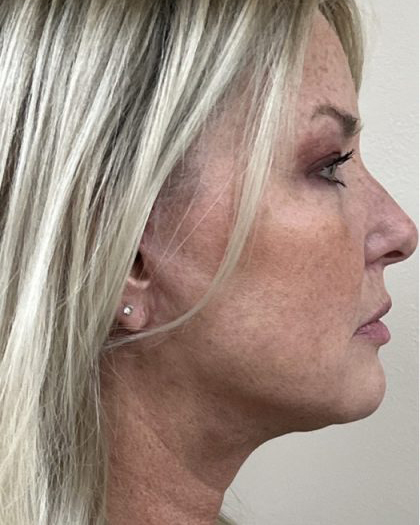 Facelift Before & After Patient #7444