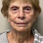 Facelift Before & After Patient #7445