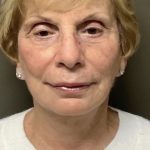 Facelift Before & After Patient #7445
