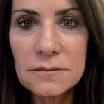 Mini Facelift Before & After Patient #7446