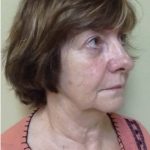 Facelift Before & After Patient #7447