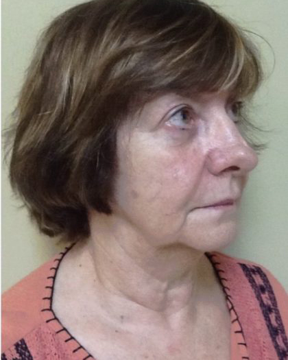 Facelift Before & After Patient #7447