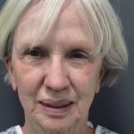 Facelift Before & After Patient #7448