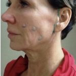 Neck Lift Before & After Patient #7449