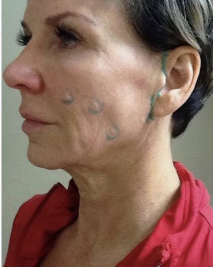 Neck Lift Before & After Patient #7449