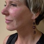 Neck Lift Before & After Patient #7449