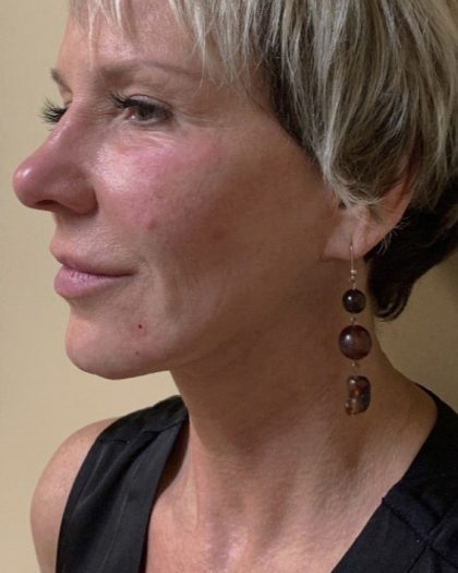Neck Lift Before & After Patient #7449