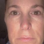 Facelift Before & After Patient #7450