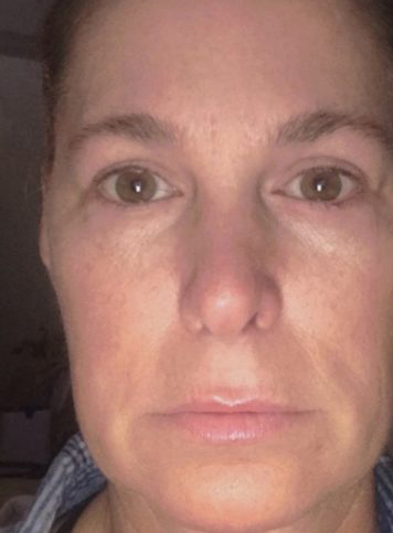 Facelift Before & After Patient #7450