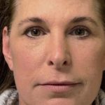 Facelift Before & After Patient #7450