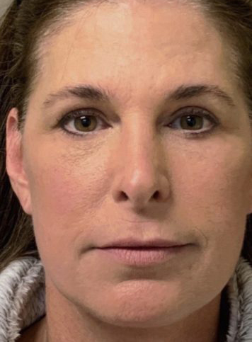 Facelift Before & After Patient #7450