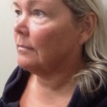 Facelift Before & After Patient #7451