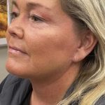 Facelift Before & After Patient #7451