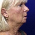Facelift Before & After Patient #7454