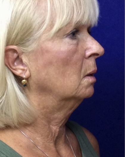 Facelift Before & After Patient #7454