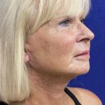 Facelift Before & After Patient #7454