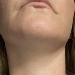 Neck Lift Before & After Patient #7458