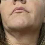 Neck Lift Before & After Patient #7458