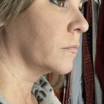 Neck Lift Before & After Patient #7459
