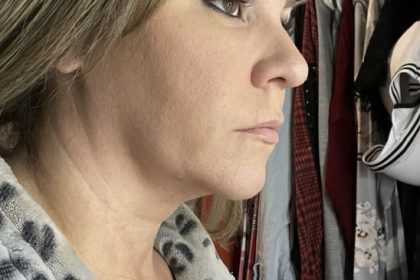 Neck Lift Before & After Patient #7459