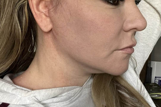 Neck Lift Before & After Patient #7459