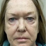 Facelift Before & After Patient #7443