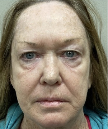Facelift Before & After Patient #7443